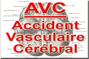 Santé : La Thrombectomie une nouvelle technique pour réduire L’Accident Vasculaire Cérébral –AVC-