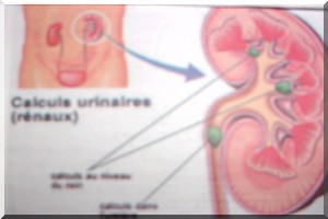 Le Calcul Rénal, Qu’est-ce que c’est ?