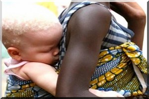  Dure réalité et difficultés d’intégration pour les personnes atteintes d’albinisme 