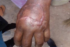 Une dame sauvée in extremis d’une gangrène