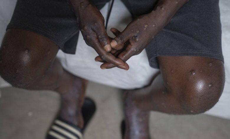 Cas de variole du singe au Sénégal : Les autorités sanitaires mauritaniennes appellent les citoyens à la vigilance